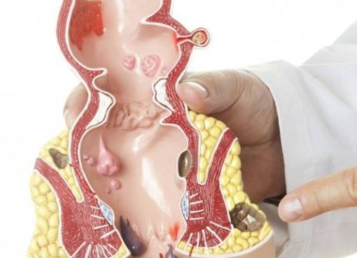 تقنيات علاج البواسير