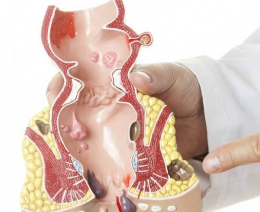 تقنيات علاج البواسير